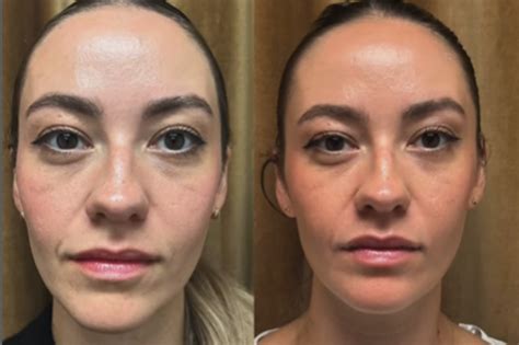 Initial and Long Term Results of Sculptra .